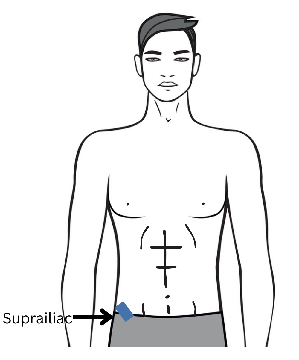 Illustration of the suprailiac skinfold site above the hip bone